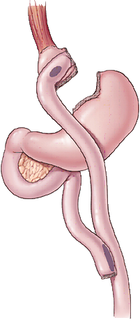 REY_Diagram Roux-en-Y Diagram