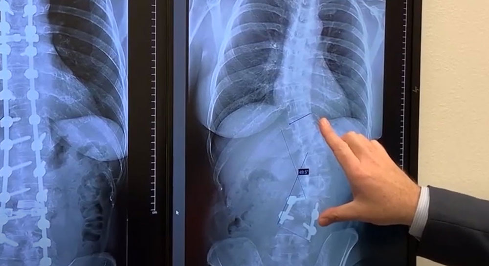 20210218_Adult-Scoliosis-X-Ray Scoliosis X-Ray