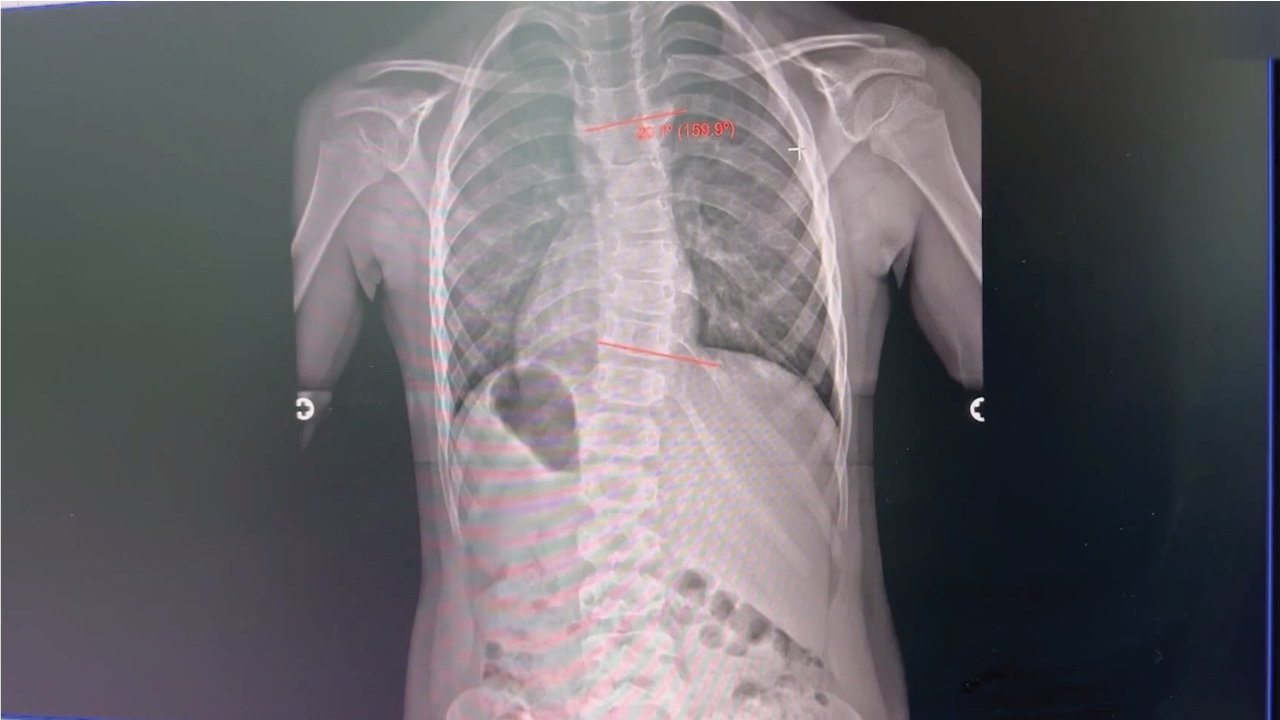 Cwmbran hospital's x-ray chair assists scoliosis patients - RAD Magazine